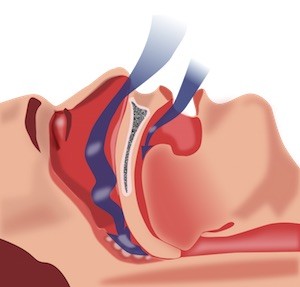 Are you suffering from Obstructive sleep apnea
