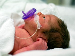 images_Brain-Bleeds-More-Likely-For-Premature-Babies